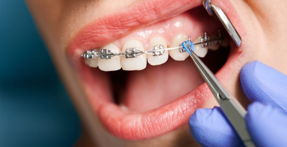 矯正歯科で受けられる治療内容とメリット